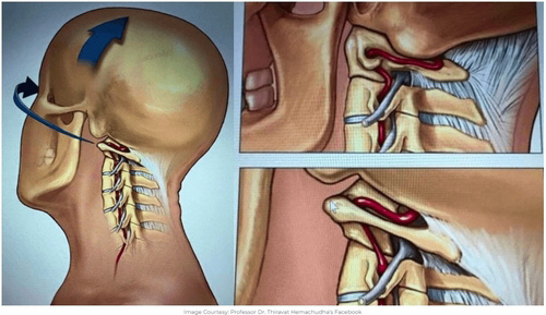 격렬한 목 마사지 시 목 혈관·신경 손상 우려.<티라밧 헤마추다 교수 페이스북 캡처, 연합뉴스>